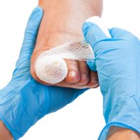 ingrowing toenail treatment