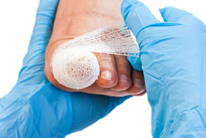 ingrowing toenail treatment
